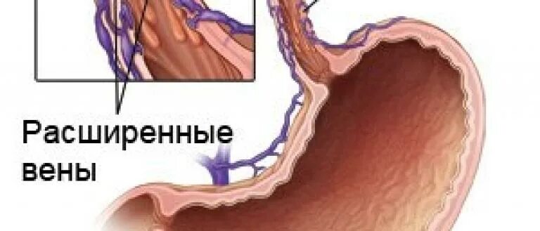варикозно расширенные вены. варикозное расширение вен (врв) нижних конечностей. варикозная болезнь вен клиника. расширенным венам. послеродовый тромбофлебит.