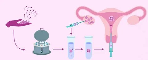 Процедура искусственного оплодотворения