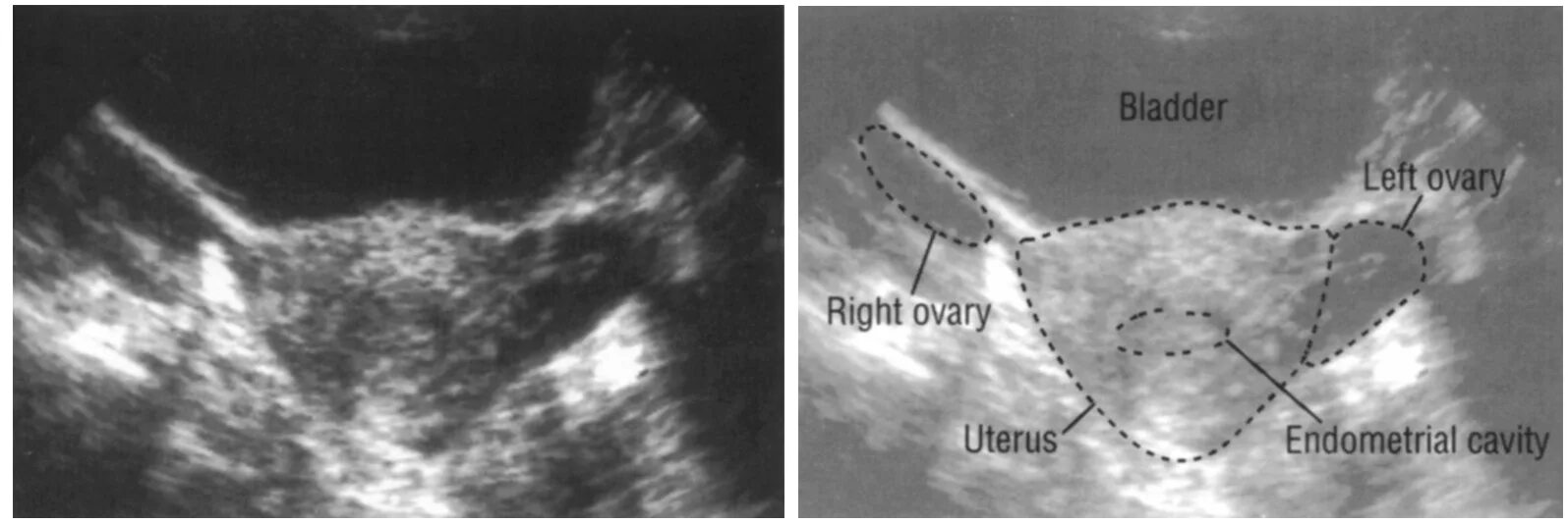 Где матка и яичники. Правый и левый яичник на УЗИ. Расположение матки по УЗИ. УЗИ расположение яичников.