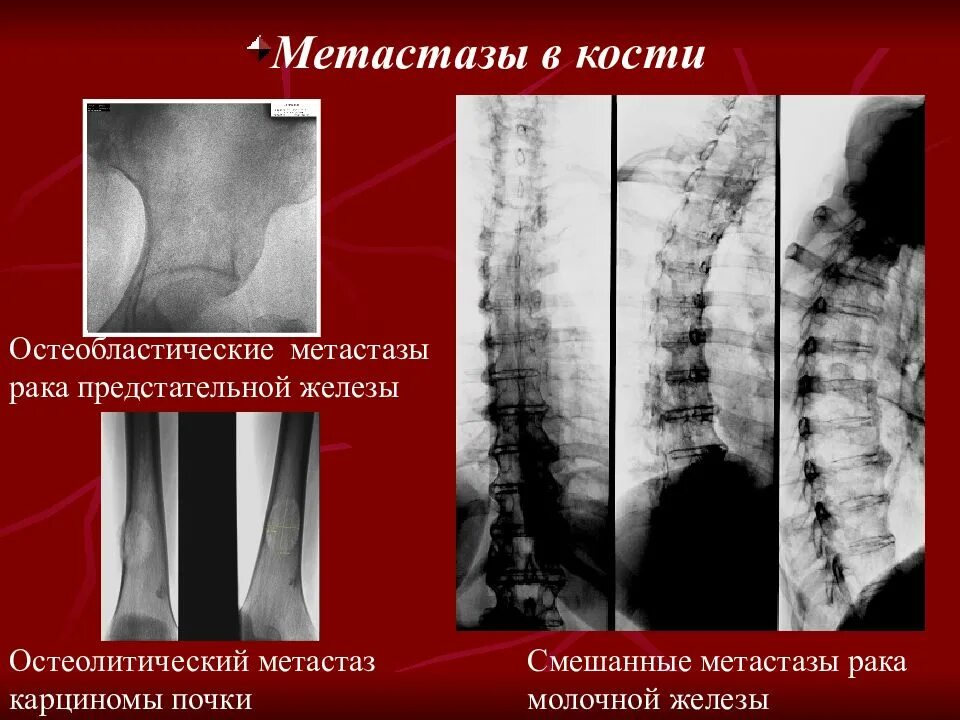 Рентгенодиагностика костей и суставов. Остеолитические и остеобластические метастазы. Остеобластические метастазы в костях. Остеобластические метастазы позвоночника.