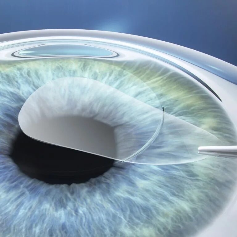 Этапы лазерной коррекции зрения ласик. Фемто ласик. Фемто ласик. Операция супер ласик. Фемто ласик.