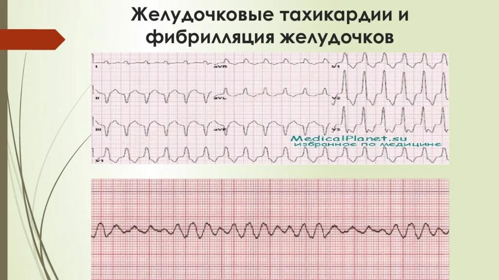 Фибрилляция предсердий тахикардия желудочков. Фибрилляция желудочков на экг. трепетание желудочков на экг. экг при фибрилляции желудочков и желудочковая тахикардия. трепетание желудочков и желудочковая тахикардия.