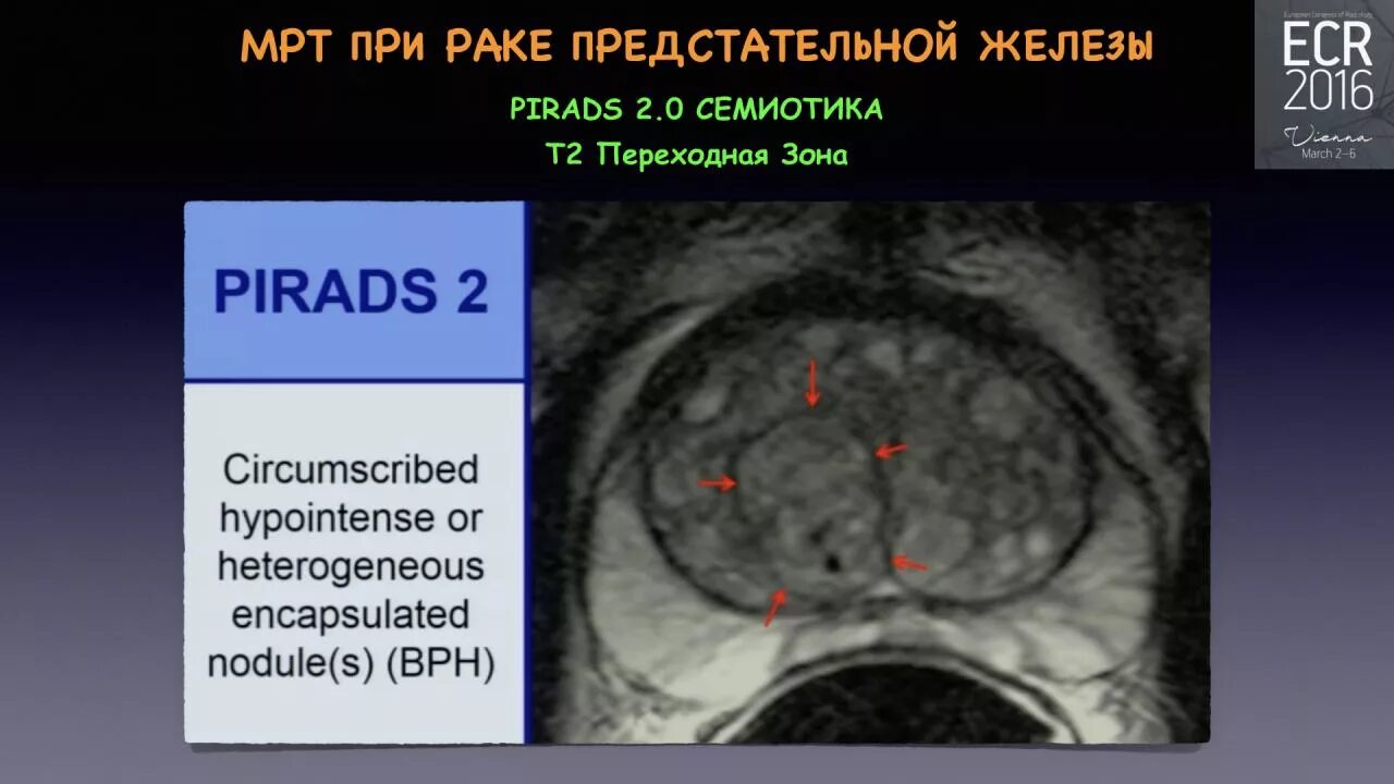 Rads 4 предстательной железы. Схема предстательной железы Pirads. Классификация предстательной железы мрт.