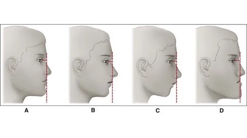 Норма лба. Правильный профиль лица. Формы лица в профиль. Типы головы сбоку. Правильная форма подбородка.