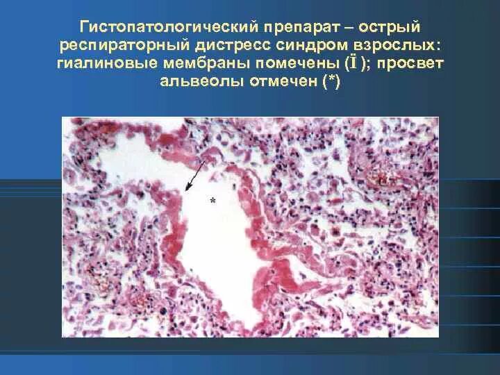 Респираторный дистресс взрослых. Болезнь гиалиновых мембран патанатомия. РДС синдром взрослых патанатомия. Гиалиновые мембраны гистология. Гиалиновые мембраны легких патанатомия.