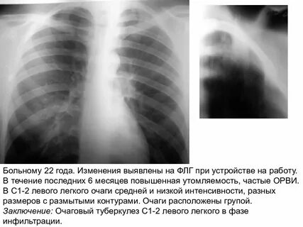 Четкие контуры очага в легком