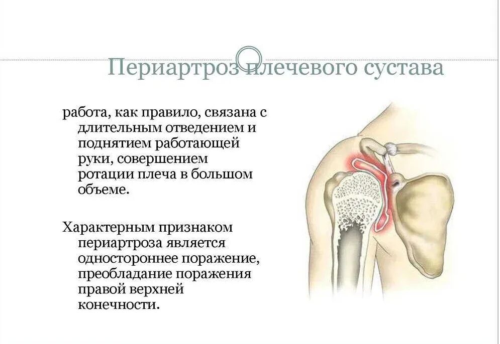 Боль в руке при поднятии и отведении. Периартроз плечевого сустава патогенез. Периартроз плеча симптомы. Плечевой лопаточный периартроз. Плечелопаточный периартрит артроз.