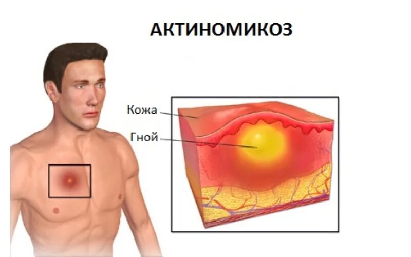 Актиномикоз это. Кожная форма актиномикоза. актиномикоз на коже человека.