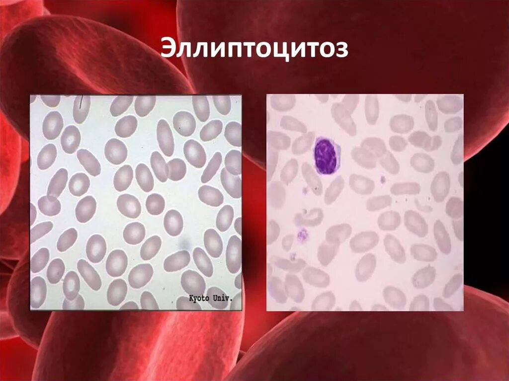 Мел при анемии