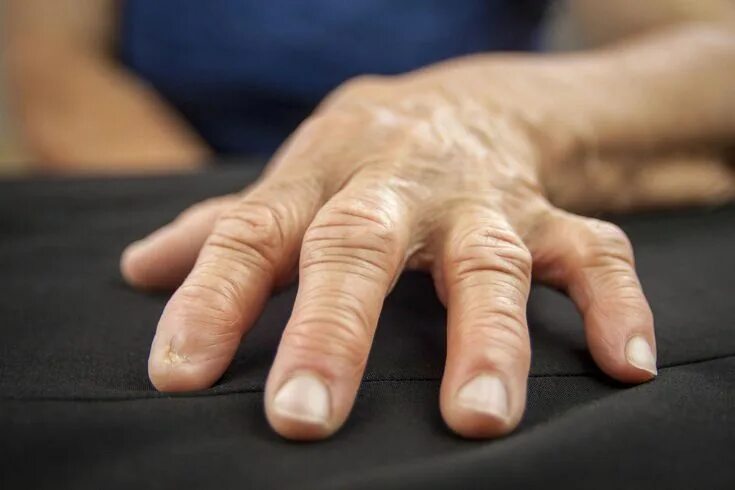 Rheumatologist All Flared Up: An Arthritis Blog