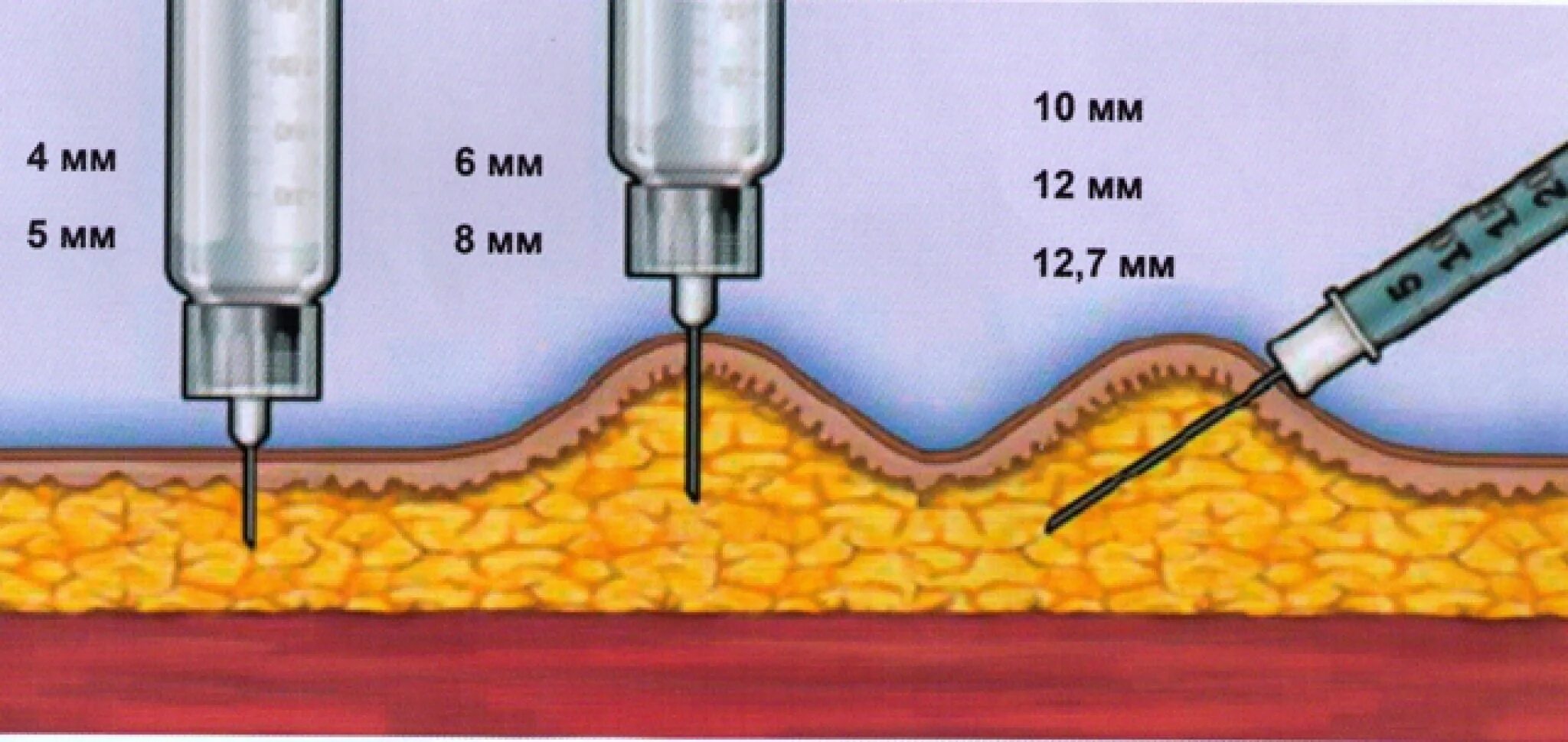 Подкожная глубина введения иглы. Введение инсулина шприцом подкожно. Укол подкожно инсулиновым шприцом. Алгоритм введения инсулина подкожно шприцем. Иглы для инъекции липолитиков.