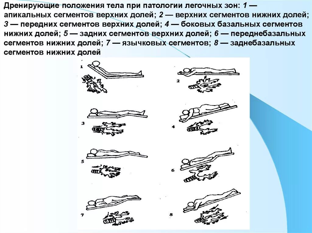 Осуществление дренажного положения при легочной патологии. Позиционный дренаж постуральный дренаж. постуральный дренаж положение квинке. дренирующее положение тела при патологии легочных зон. дренажное положение тела.