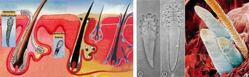 Клещи паразиты таблетки. Железница (клещ демодекс. Демодекс Железница угревая. Демодекоз (угревая Железница).