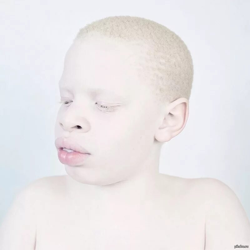 Альбинизм негроидная раса. Афроазиат альбинос. Альбинос негроидной расы.
