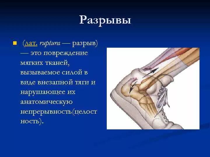 Растяжение и разрыв мягких тканей. Взять разрыв