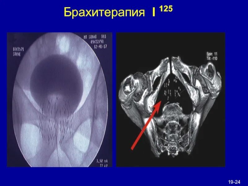 Брахитерапия простаты. Сцинтиграфия простаты. брахитерапия предстательной железы на кт. брахитерапия предстательной железы кт картина.