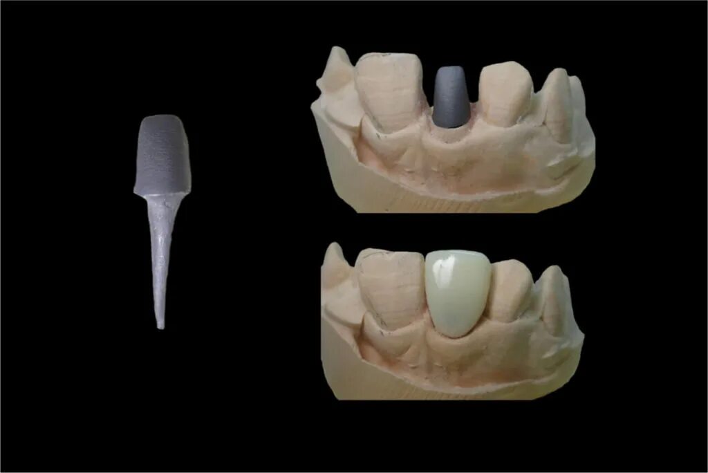 Core crowns