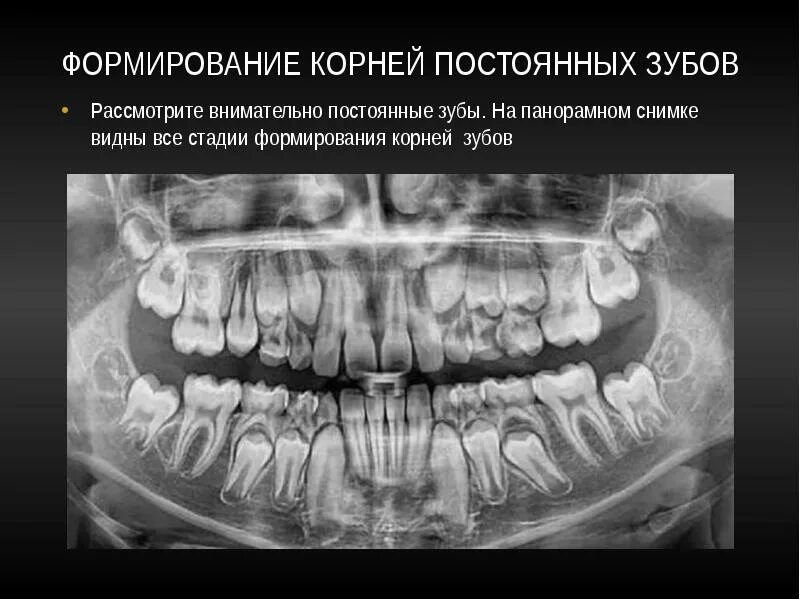 Стадии формирования корня временных зубов. Снимок ОПТГ периодонтит. Рентген постоянных зубов.