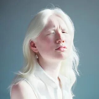 Альбинизм сетчатки