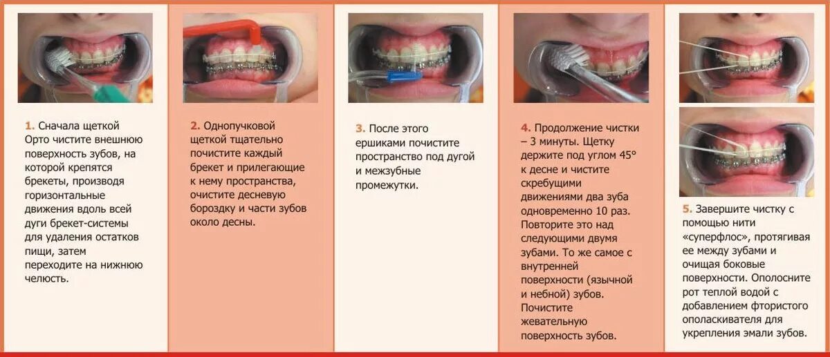 Чистить зубы с бреке ами. Гигиена полости рта памятка. Правильная чистка зубов.