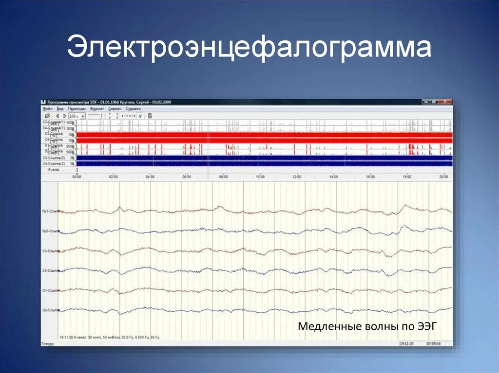 Медленные волны на ээг. Нейрофизиологический мониторинг. Методы нейрофизиологических исследований. Интраоперационный нейрофизиологический мониторинг.