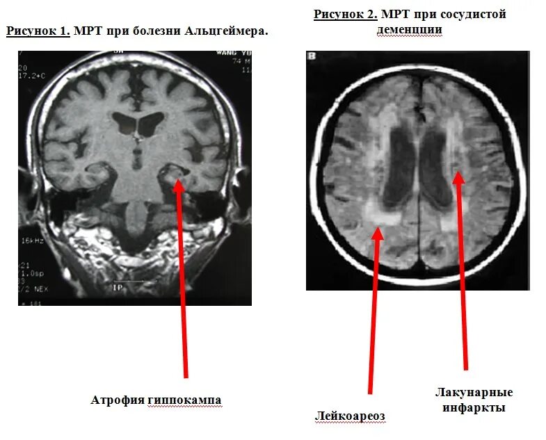 Атрофия вещества головного мозга. Деменция на мрт. Сосудистая деменция мрт. Мрт при деменции. Болезнь Альцгеймера на кт.