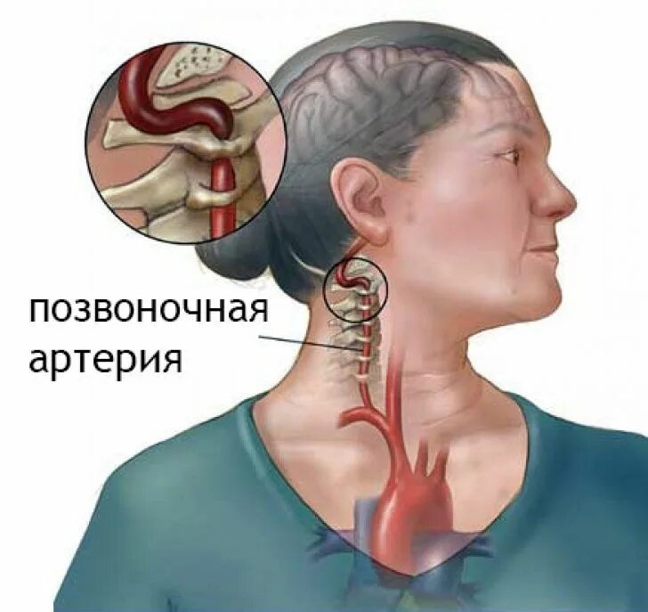 Как лечить стеноз шеи
