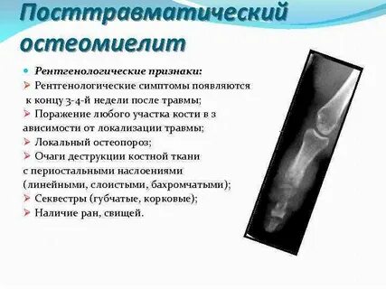 Острый остеомиелит признаки
