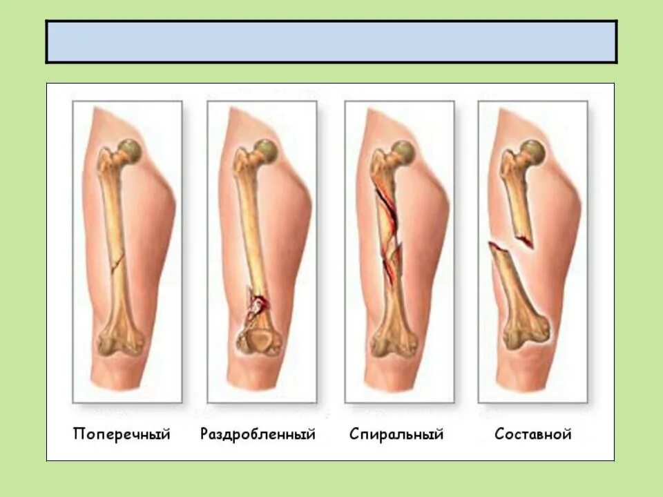 Сколько заживает бедро. Формы переломов костей.