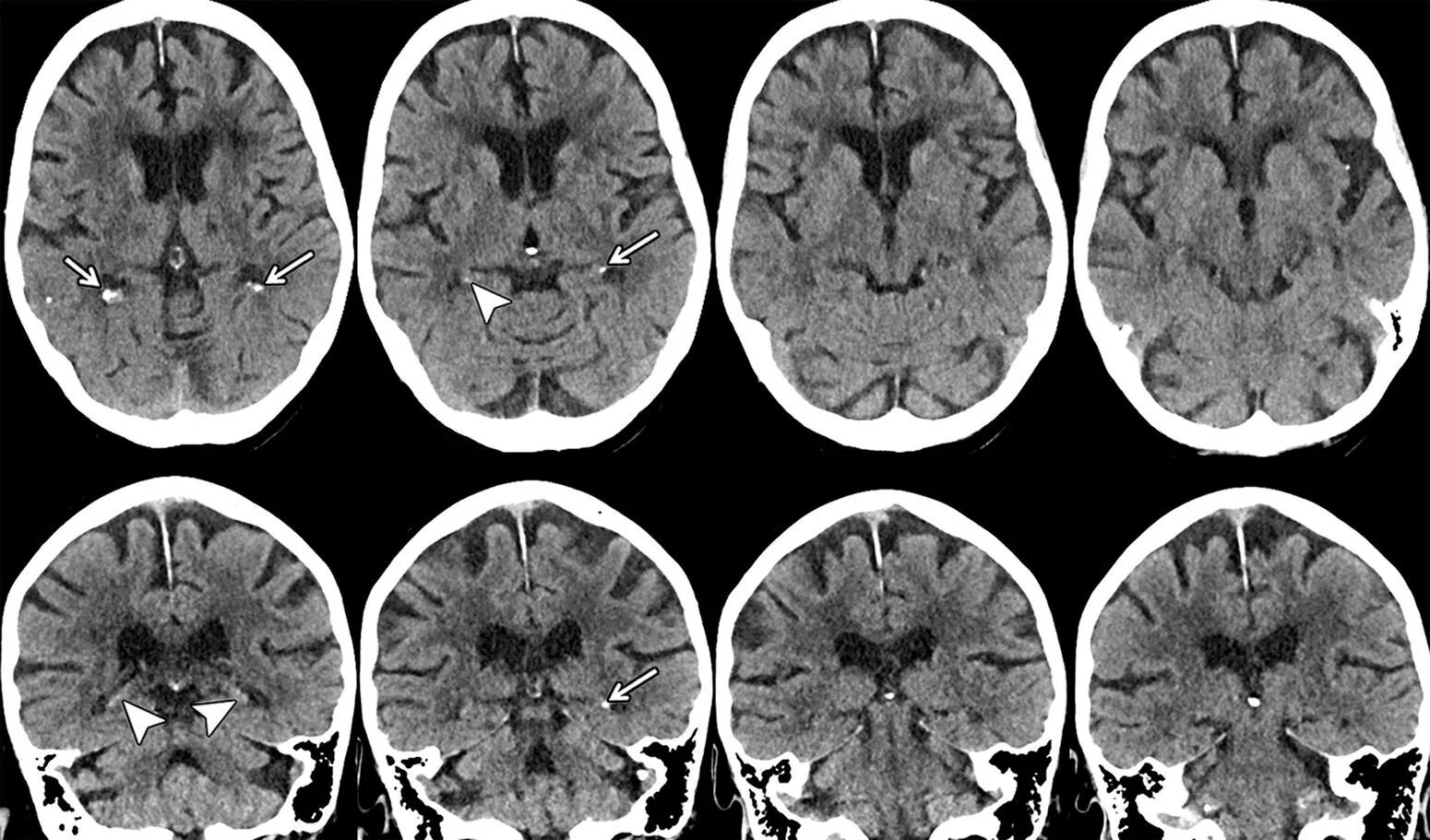 Церебральная микроангиопатия мрт. Микроангиопатия головного мозга на кт. Церебральная микроангиопатия кт. Снимок кт головного мозга.