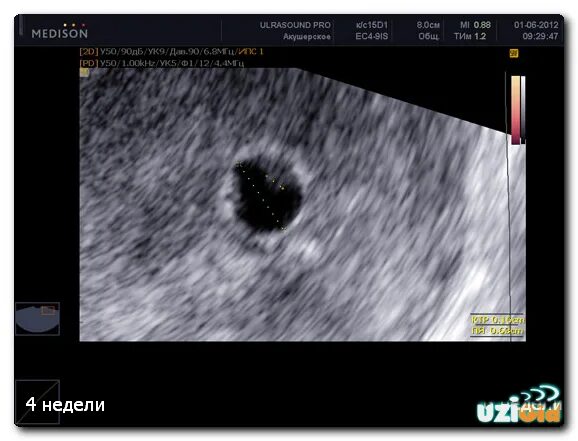 Ошибка узи на неделю. 4 Недели беременности фото плода на УЗИ. УЗИ 4 недели беременности. УЗИ 3-4 недели беременности фото плода на УЗИ. Эмбрион на 4 неделе беременности УЗИ.