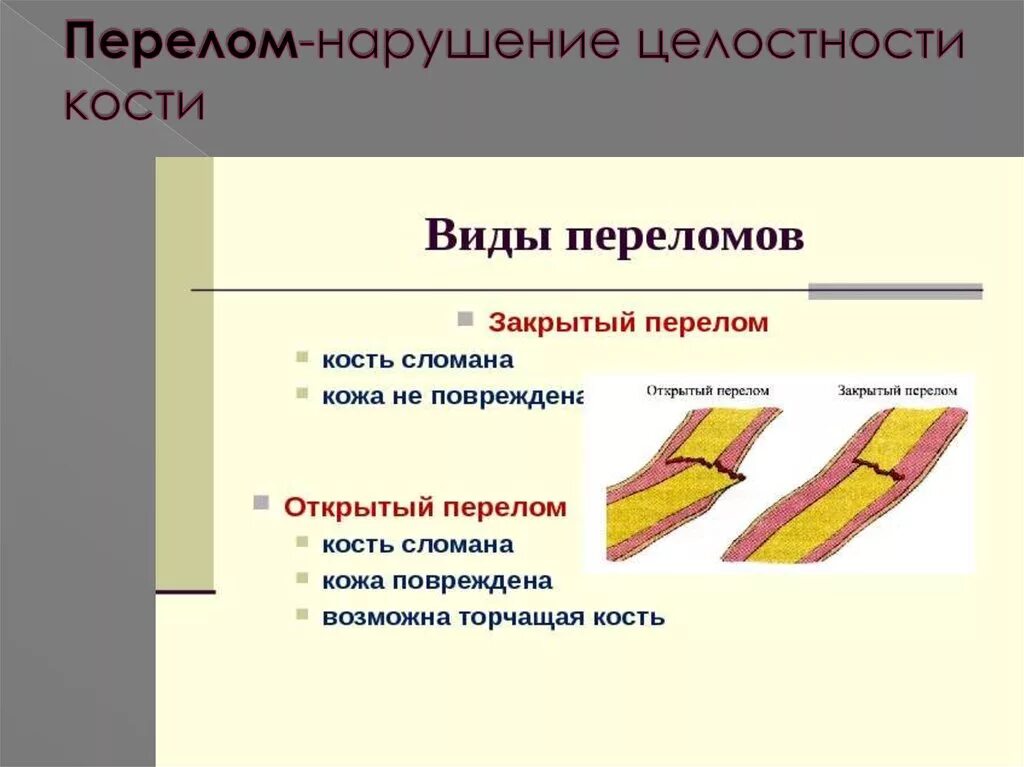 Типы закрытых переломов. Типы переломов костей конечностей. Переломы виды переломов симптомы. Перелом его виды и признаки.