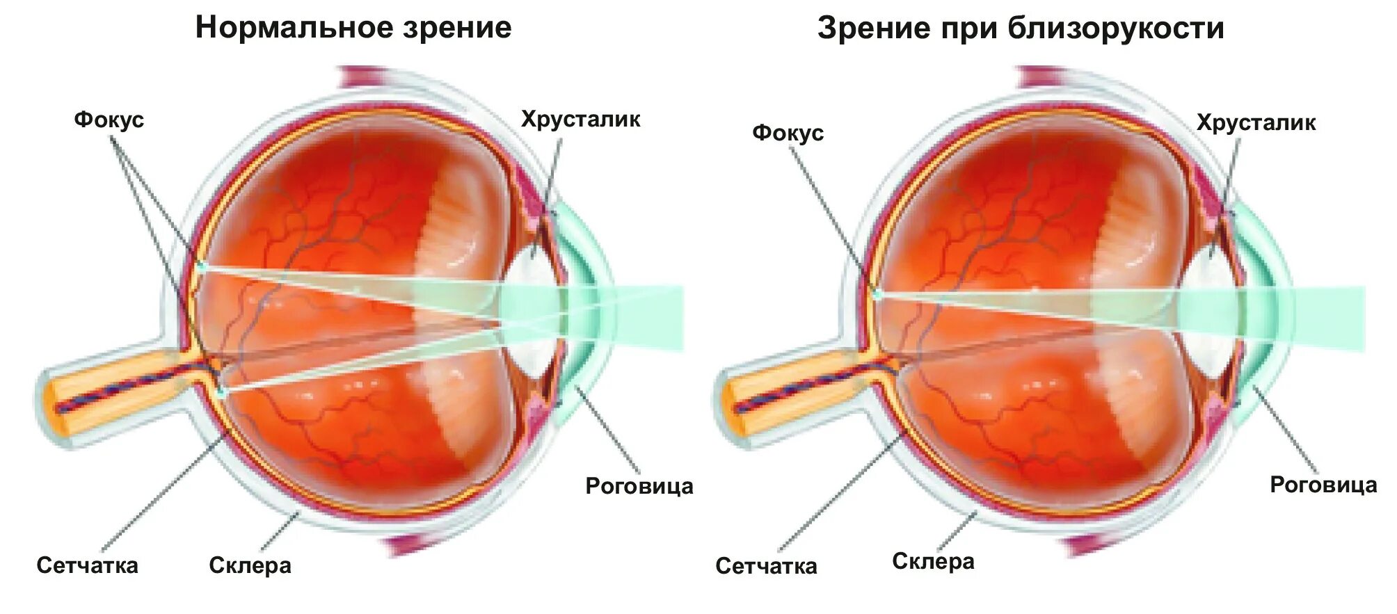 Близорукость сетчатка. Астигматизм схема. Линзы для астигматизма. Близорукость хрусталик. Какое зрение при дальнозоркости