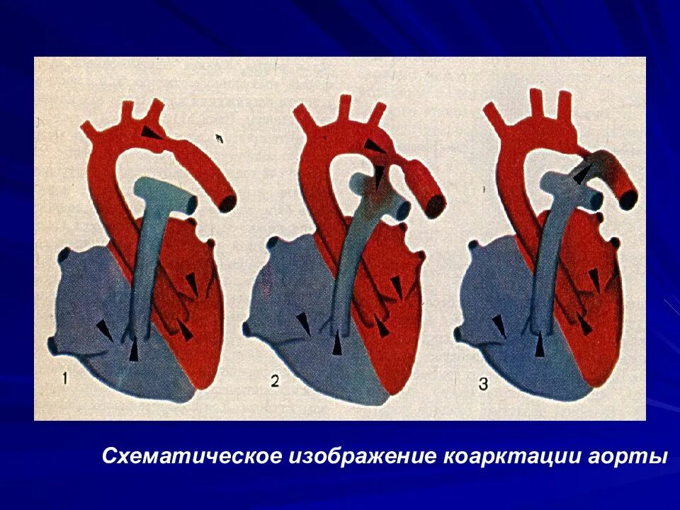 Сопротивление аорты. Коарктация аорты патологическая анатомия. клиническая картина коарктации аорты. коарктация аорты гемодинамика. юкстадуктальная коарктация аорты.