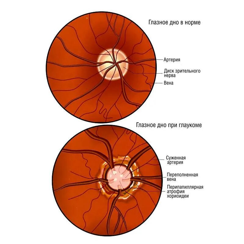 Норма зрительного нерва. Схема патологии глазного дна. Глаукомная экскавация диска зрительного нерва. Показатель экскавации диска зрительного нерва. Нормальные сосуды глазного дна.