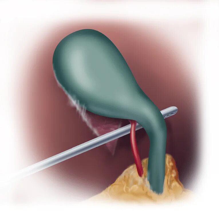 После удаления желчного пузыря. Антреоградна холецистэктомия. Напраскапик холецистэктомия. Тракция желчного пузыря это.