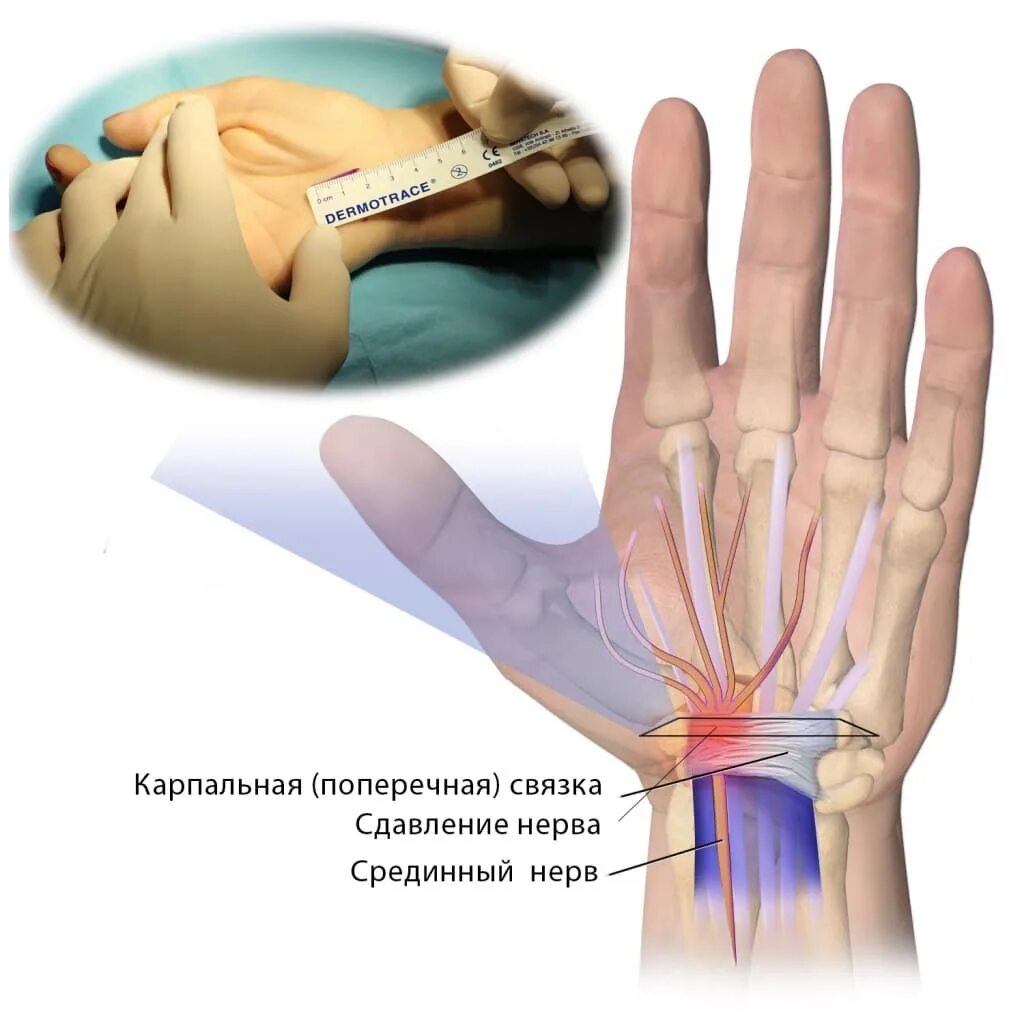 Синдром карпального клапана кисти. Карпальный синдром лучезапястного сустава. Туннельный синдром запястья кисти. Карпальный туннельный. Туннельный синдром после операции