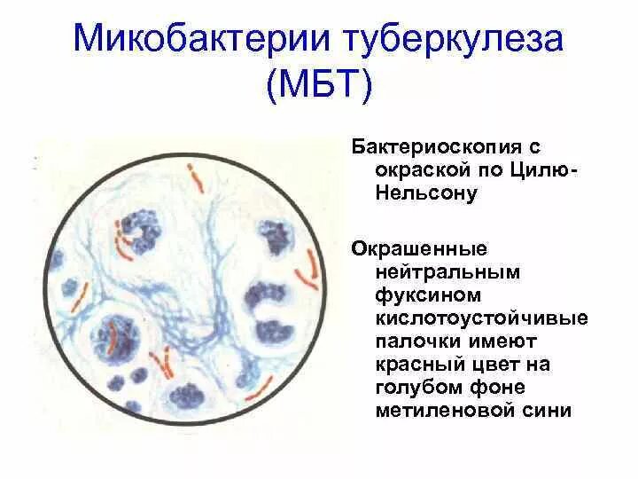 Мокрота на мбт. Микроскопия мокроты на туберкулез. Бактериоскопия мокроты по Цилю Нильсену. Микроскопия мокроты на МБТ. Микроскопия мокроты при туберкулезе.