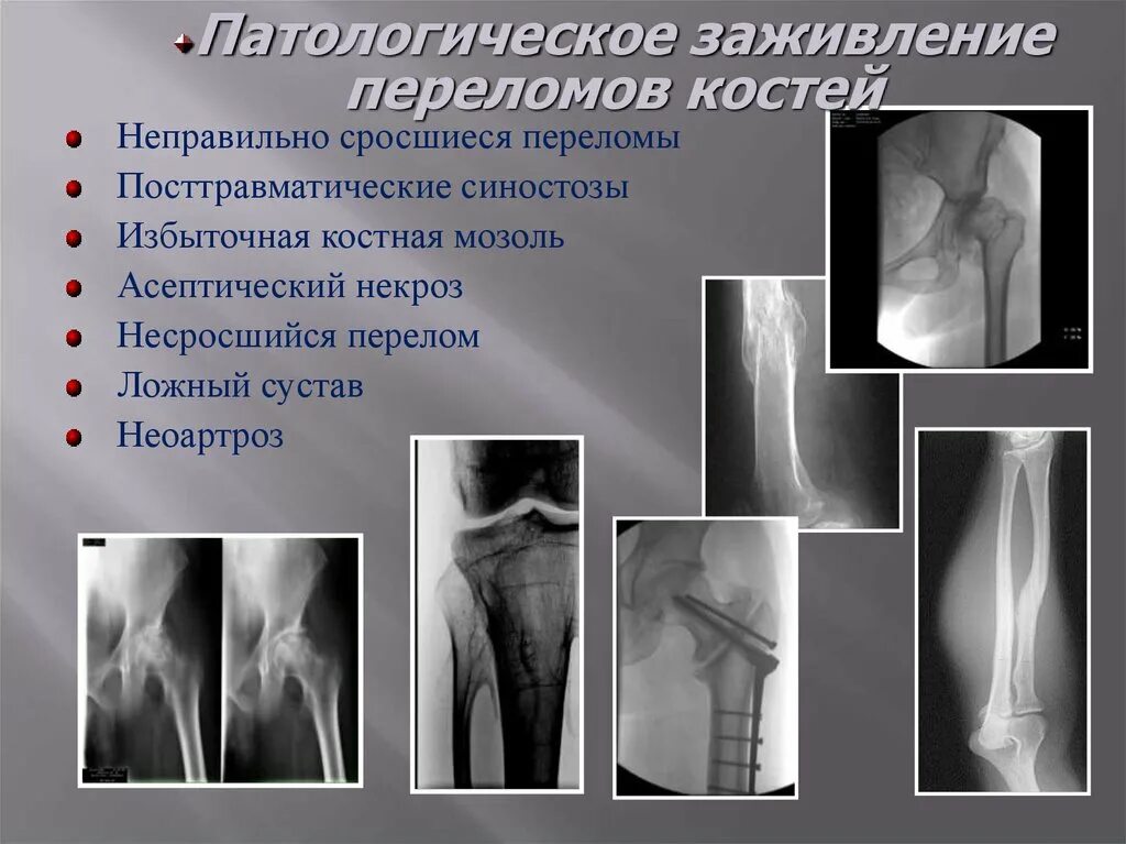 Эндостальная костная мозоль рентген. Этапы сращения перелома. Срастание костей при переломе. Трещина срослась