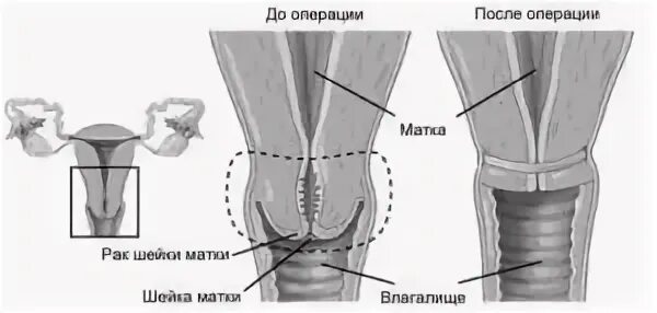 Как выглядит внутри после удаления матки Удалили матку что осталось: найдено 85 картинок