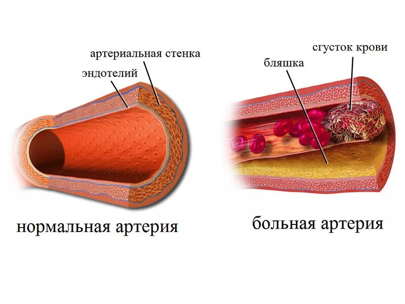 Атеросклерозная бляшка. Фиброзная атеросклеротическая бляшка.