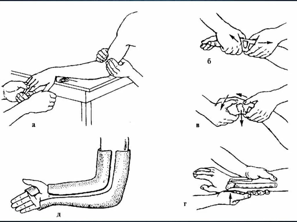 Ручная репозиция костных отломков. Закрытая и открытая репозиция отломков костей. Репозиция костных отломков при переломах. Одномоментная ручная репозиция переломов. Методы фиксации костных отломков перелом костей носа.