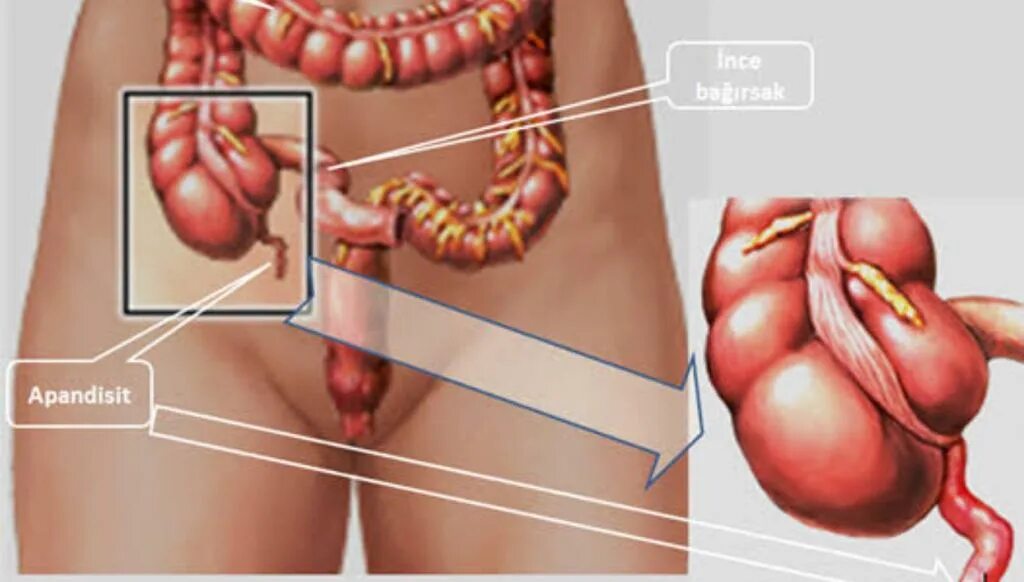 Где находится придатки у женщины фото. Анатомия человека аппендицит. Расположение аппендицита у человека.