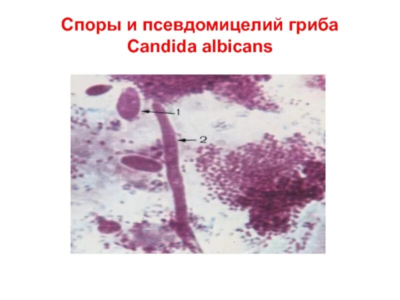 Споры candida. Дрожжеподобные грибы: псевдомицелий. Споры гриба кандида в мазке. Мазок кандида псевдомицелий. Псевдомицелий гриба рода Candida.