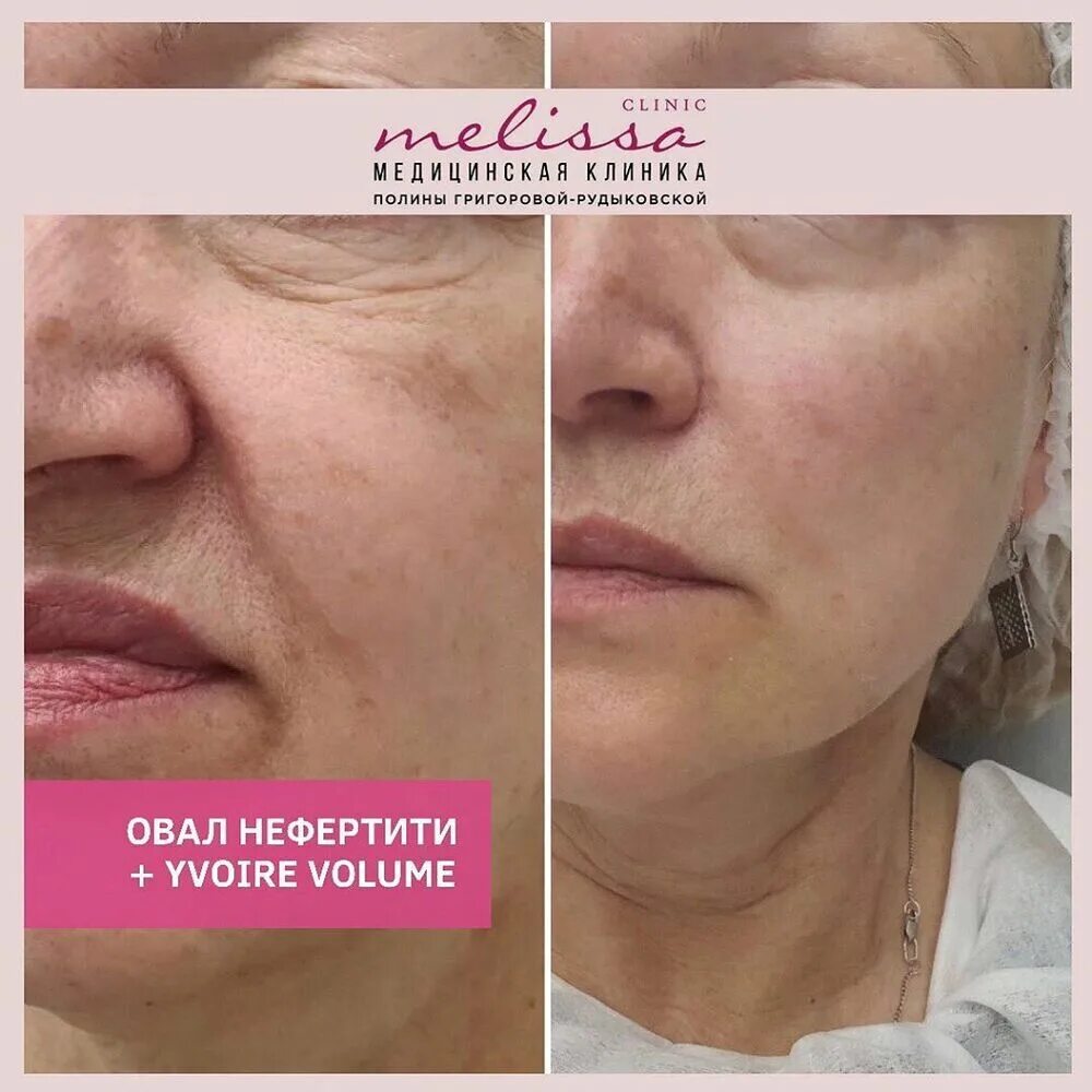 инъекция ксеомина отзывы. ксеомин 100 единиц. ботулинотерапия xeomin. ксеомин до и после. ксеомин 100.