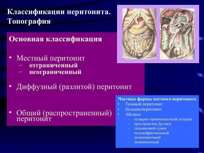 Параканкрозный перитонит. Подпеченочный перитонит. Фиброзно Гнойный перитонит.