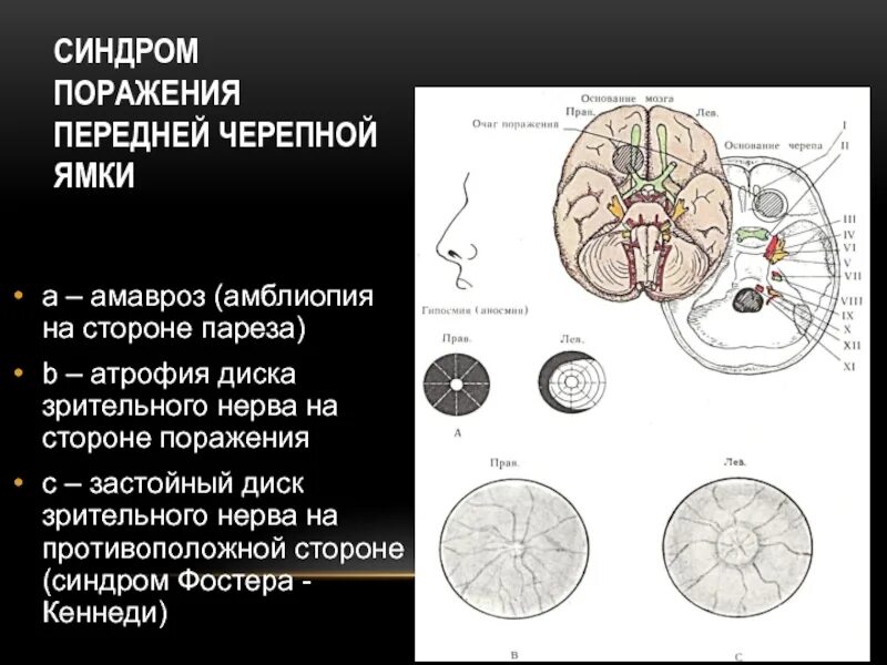 Периневральное пространство зрительного нерва. Синдром Фостера Кеннеди. Синдром Фостера Кеннеди неврология. Периневральные пространства зрительных нервов расширены. Синдромы поражения зрительного нерва.