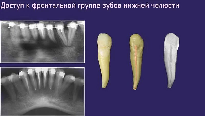 Киста зуба.