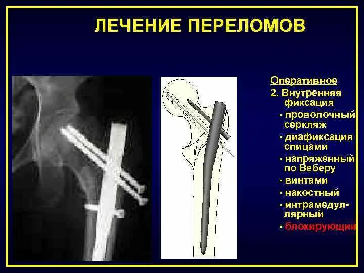 Оперативное лечение перелома костей. Оперативное лечение переломов. Оперативное решение переломов.