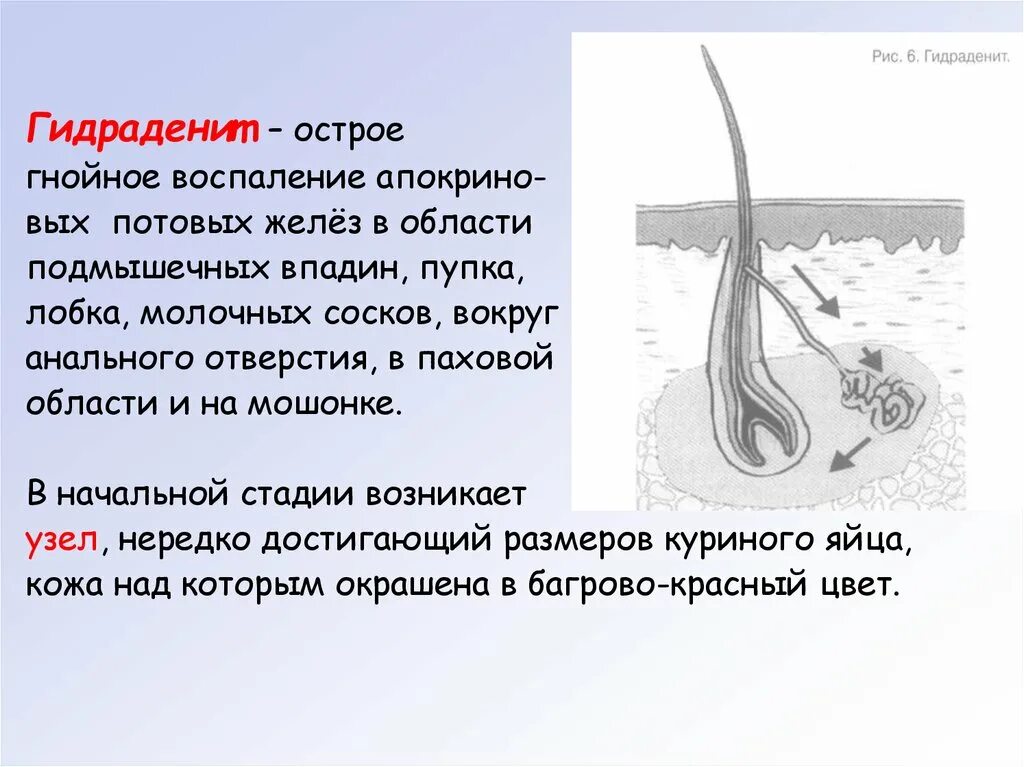Воспаление луковицы волоса. Воспаление потовой железы. Лечение воспаления потовой железы. Воспаление апокриновых потовых желез. Гидраденит это воспаление.
